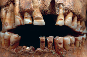 Detail of the filed teeth from the male individual in grave 25 from Slite, Othem parish, Gotland.