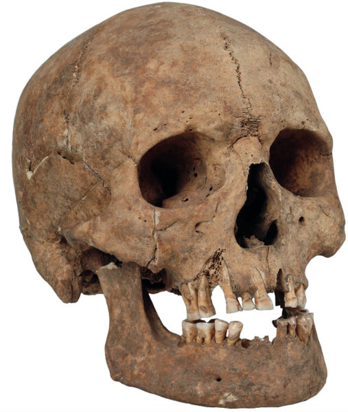 Skull of a male individual with filed teeth and healed fracture from grave 25, Slite, Othem parish, Gotland.