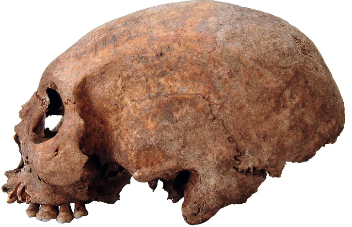 Artificially modified skull from the female individual in grave 192 from Havor, Hablingbo parish, Gotland.