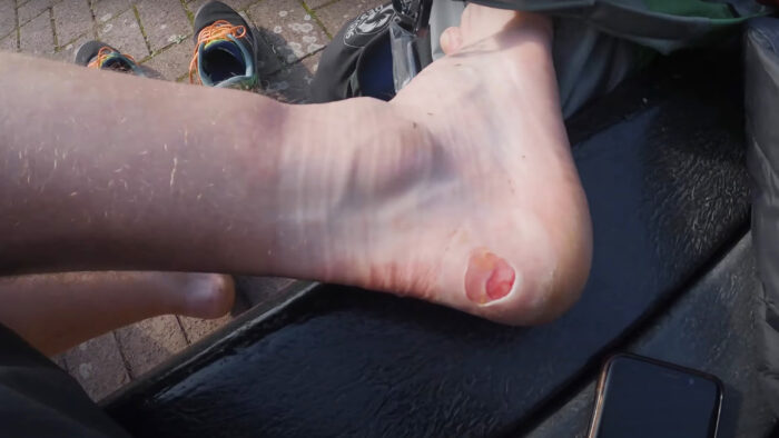 a close-up of a heavily blistered heel