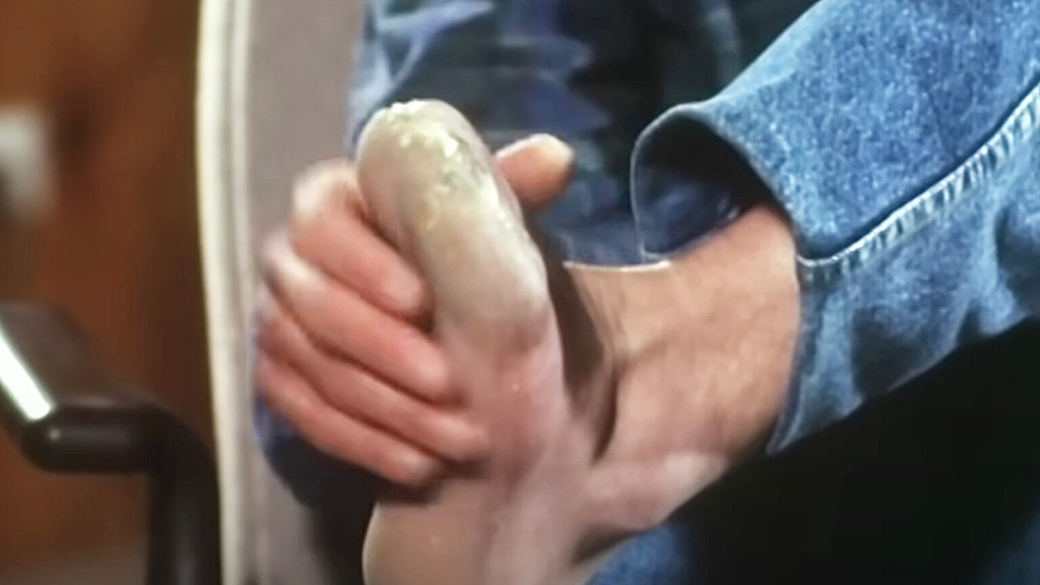 closeup of foot, minus toes lost to frostbite