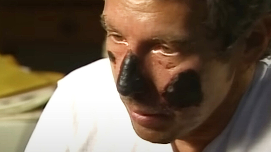 man with severely frostbitten nose and face