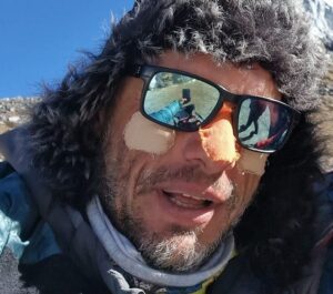 Close shot of Kowalewski with sunglases and tape on his face.