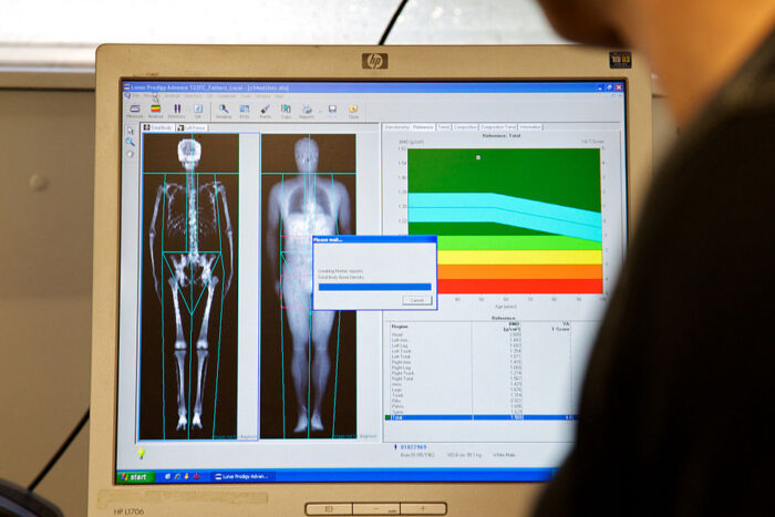 A dual-energy X-ray absorptiometry (DEXA) scanning technique was used to measure bone mineral density and body composition.