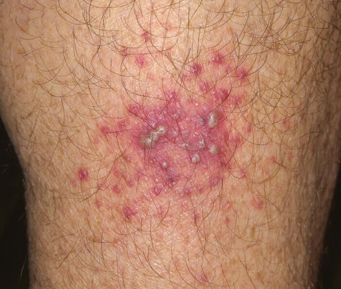 blistering from manchineel tree