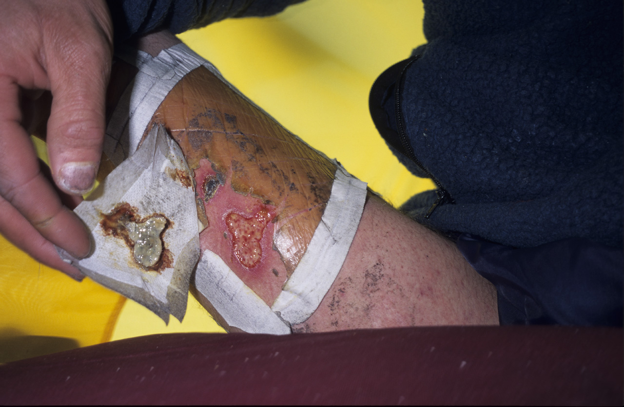 peeling back bandage to reveal skin wound