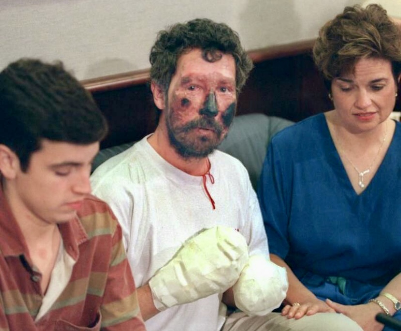 One of the survivors, Beck Weathers, with severe frostbite.