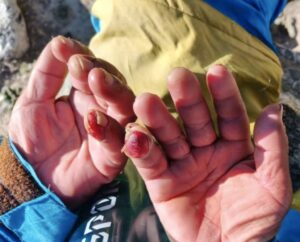 Hillary Dawa Sherpa's hands after the grueling solo descent and self-rescue on Everest, on June 4, 2026.