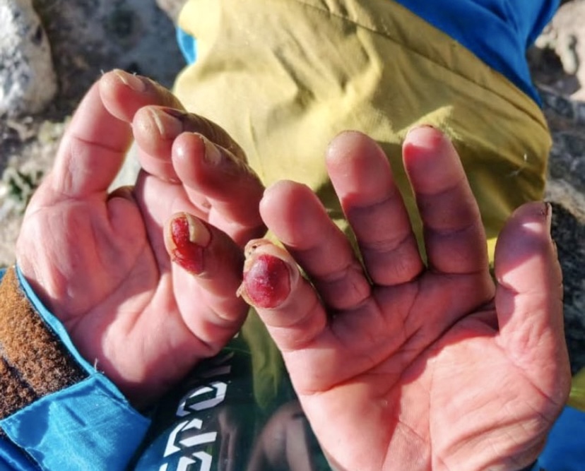 Hillary Dawa Sherpa's hands after the grueling solo descent and self-rescue on Everest, on June 4, 2026.