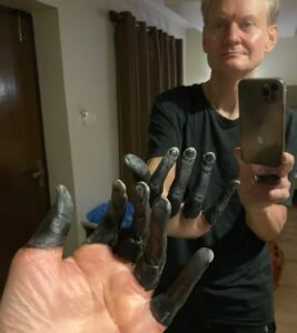 badly frostbitten fingers selfie