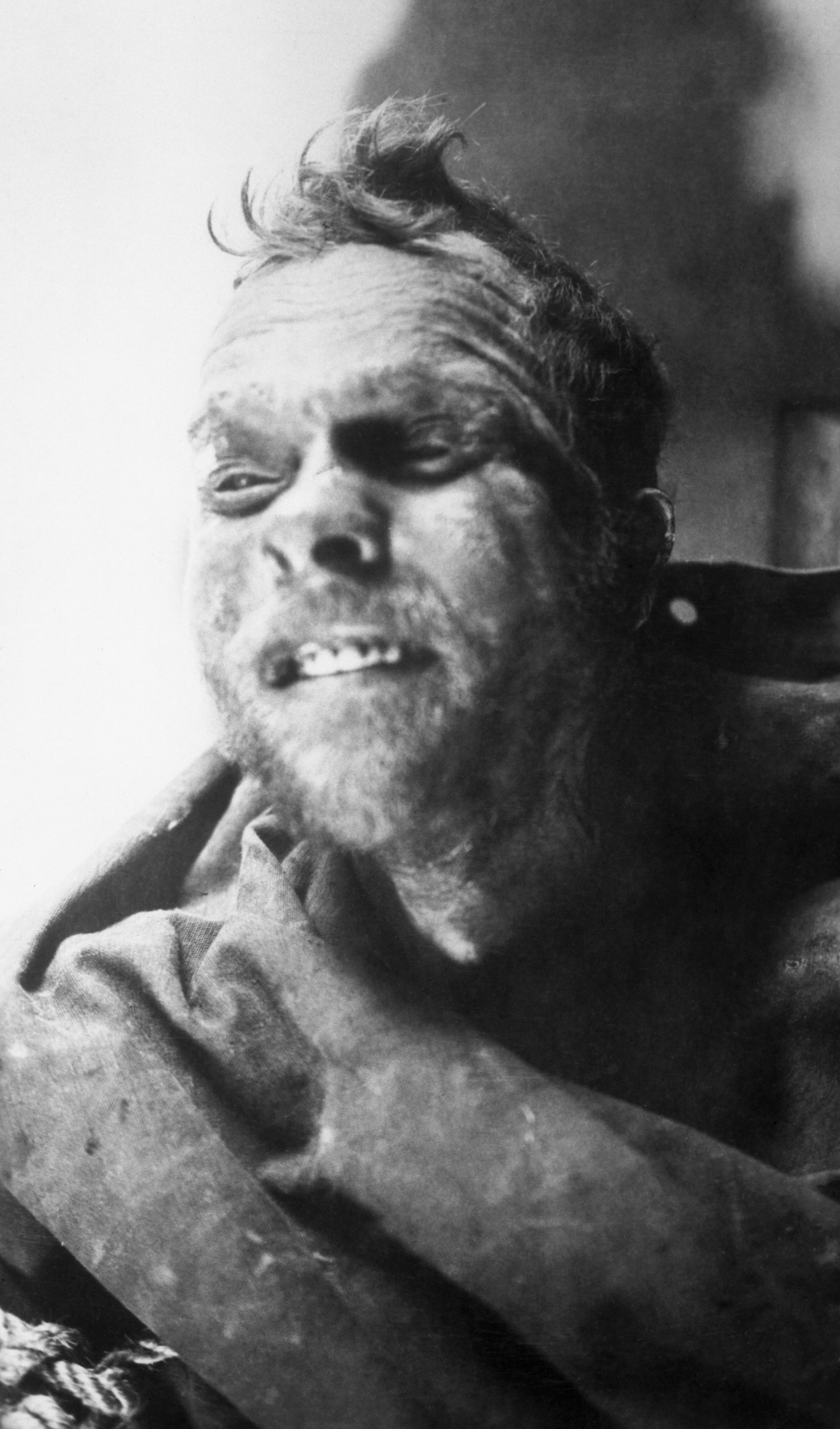 Albert Johnson's corpse. 