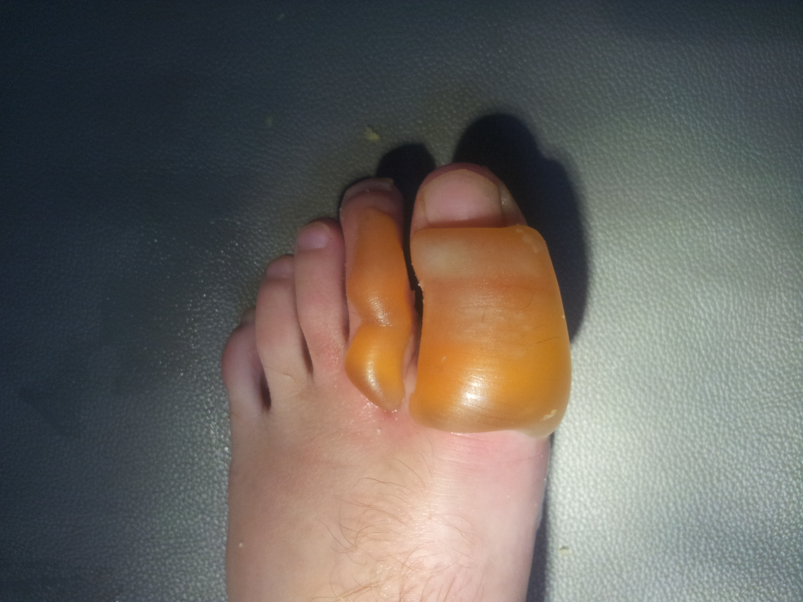 A badly blistered foot after a centipede bite
